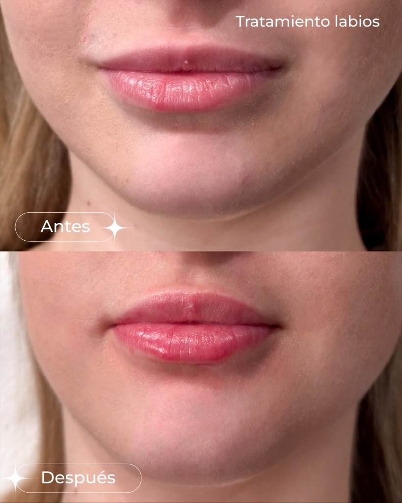 Tratamiento Labios