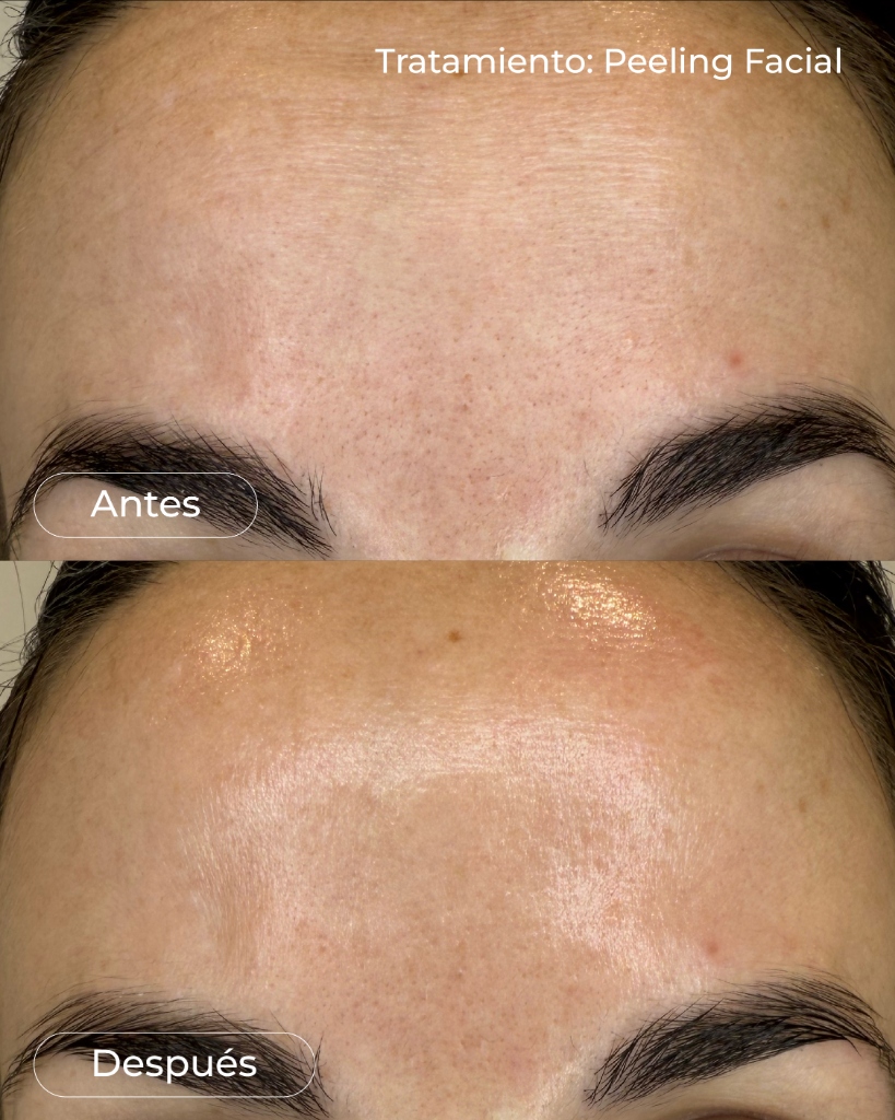 Peeling Facial